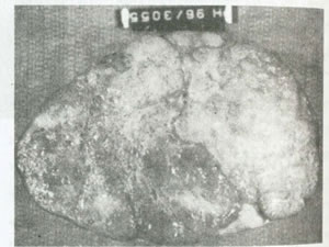 بيماريهاي تخمدان و لوله هاي رحمي چیست؟(1)